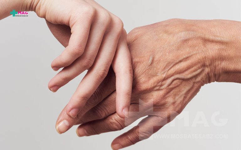 چروک دست