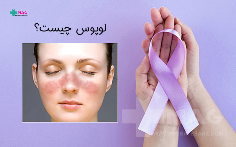 بیماری لوپوس