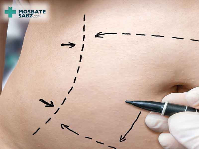 جراحی ابدومینوپلاستی چیست؟