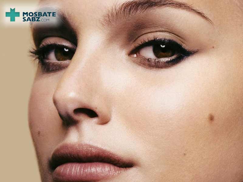 چگونه خال صورت را از بین ببریم؟