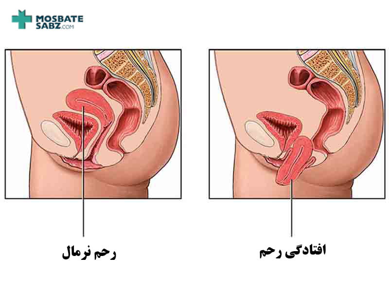 افتادگی رحم