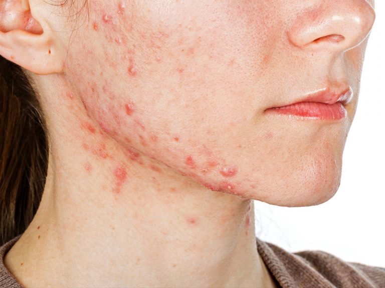 برای رهایی از جوش های قرمز بعد از اپیلاسیون چه کنیم ؟