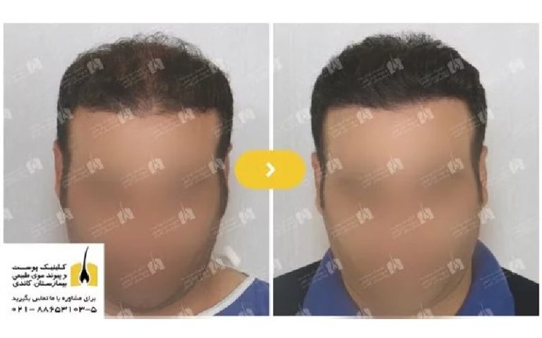 آشنایی با انواع روش‌های کاشت مو و مزایای آن‌ها