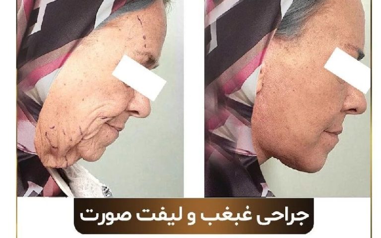 لیپوماتیک