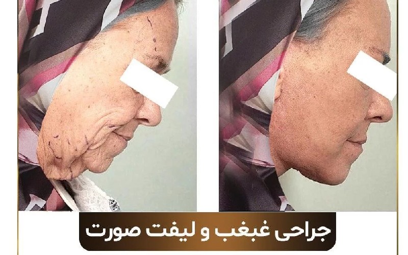 لیپوماتیک