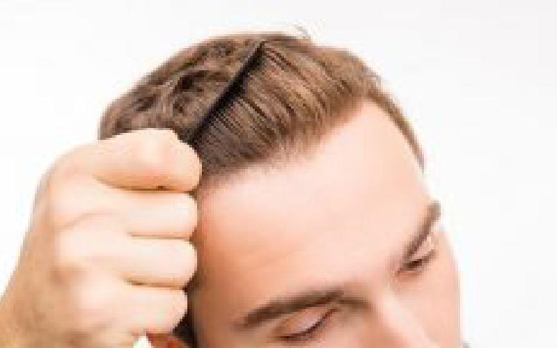 کاشت مو به روش fit