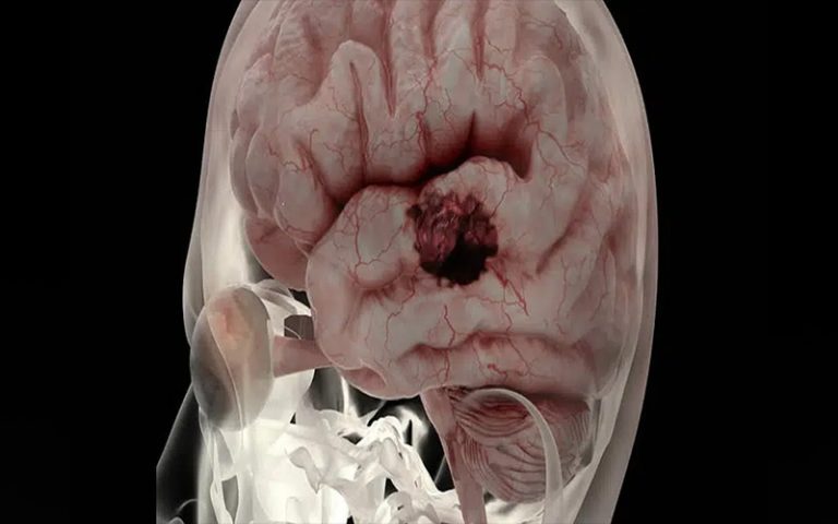 بهترین متخصص مغز و اعصاب در زمینه سکته مغزی