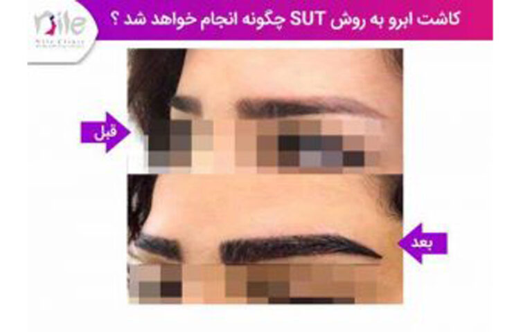 هزینه کاشت ابرو به روش SUT در بهترین کلینیک زیبایی