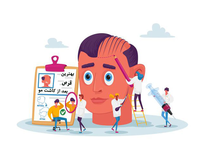 بهترین قرص بعد از کاشت مو