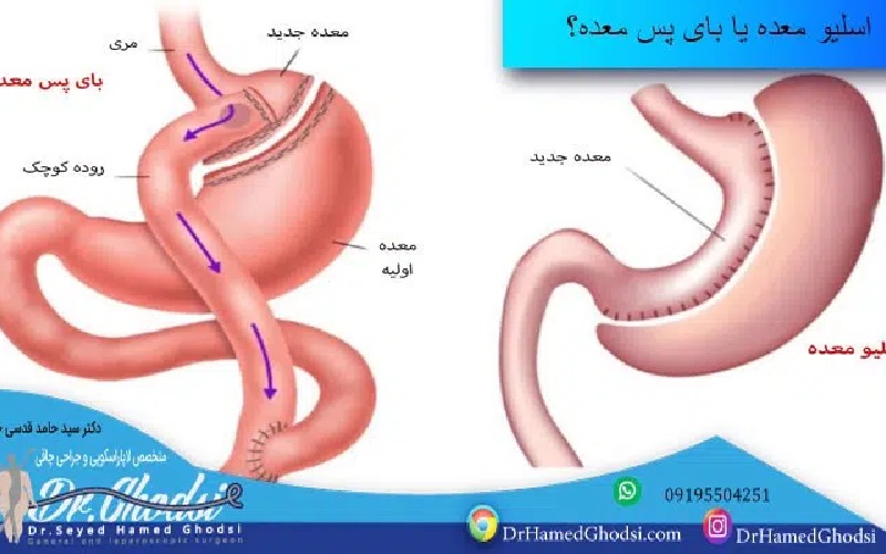 اسلیو معده یا بای پس معده