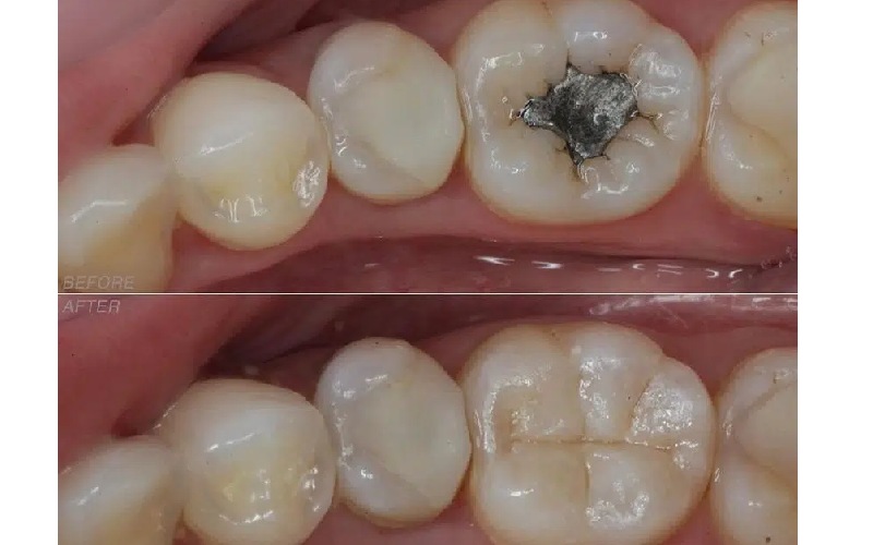 تفاوت، بررسی و مقایسه آمالگام و کامپوزیت دندانپزشکی