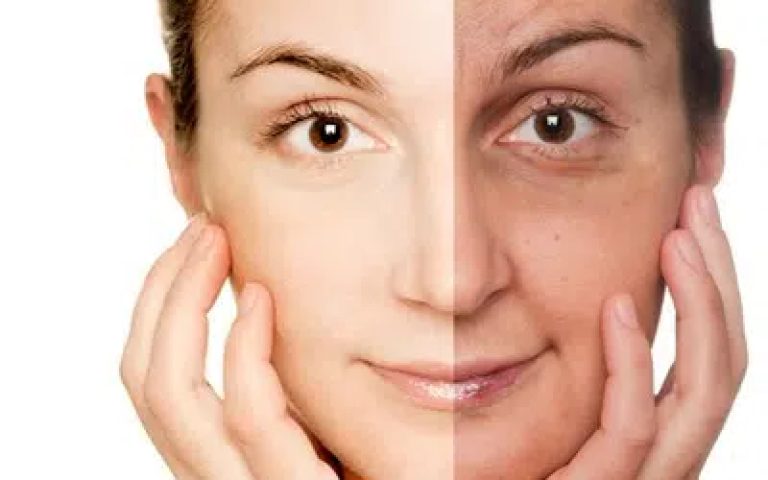 جوانسازی پوست با کربوکسی تراپی و مزوتراپی