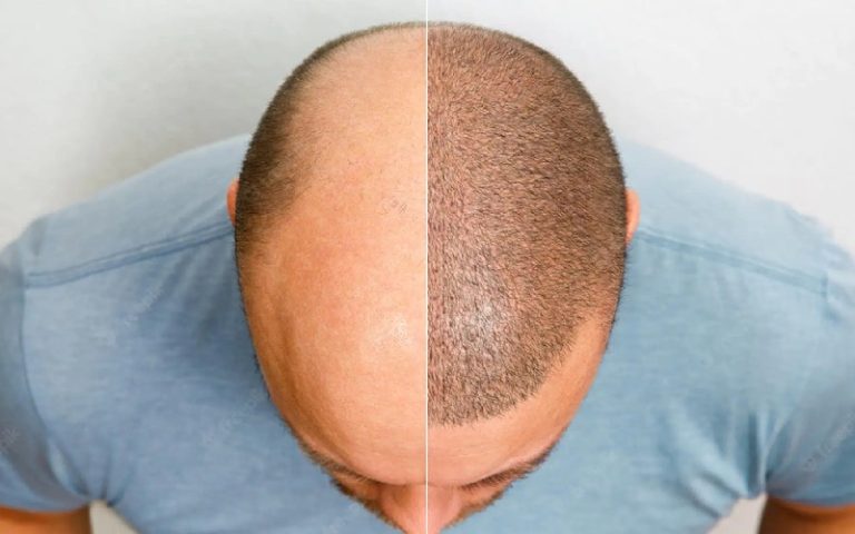 روش های متعدد کاشت مو چیست