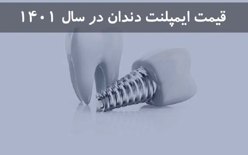 ایمپلنت دندان در سال 1401