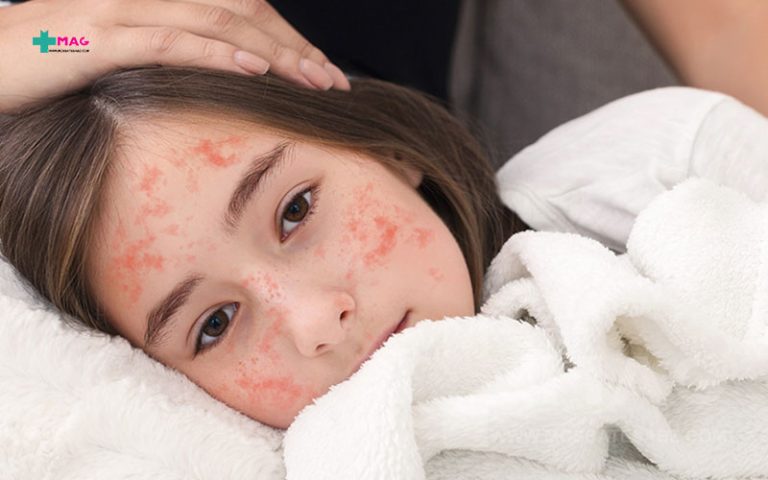 سرخک چیست ؟