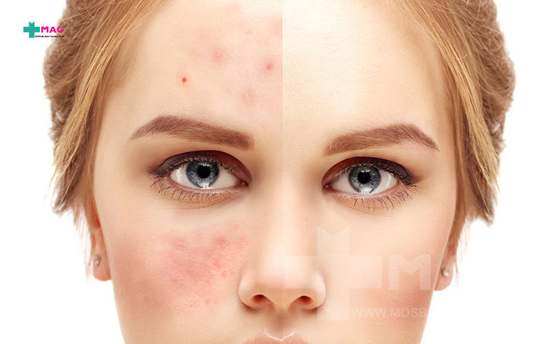 تاثیر استرس روی پوست