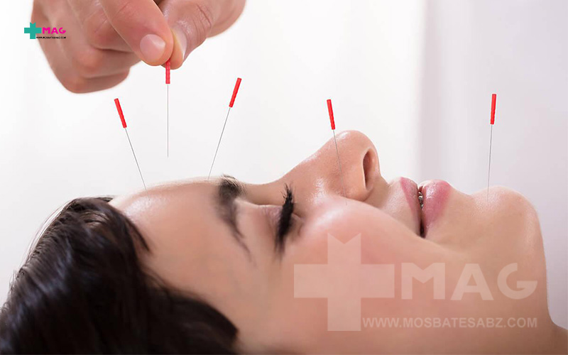بررسی تاثیر طب سوزنی بر تیرگی دور چشم