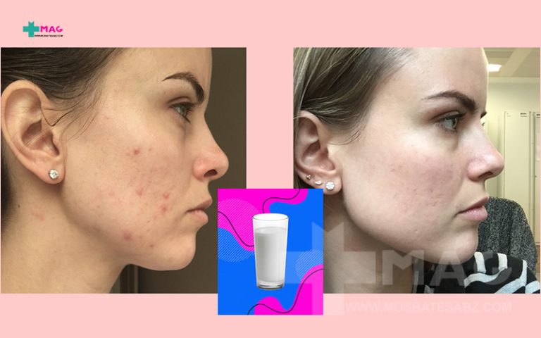 تاثیر لبنیات روی پوست و آکنه