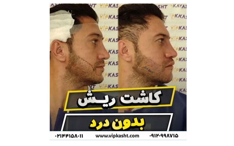متخصص کاشت ریش در تهران