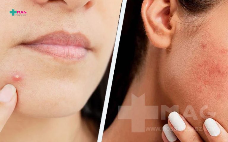 تفاوت آکنه و جوش