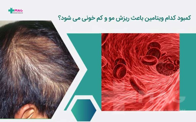 ریزش مو و کم خونی