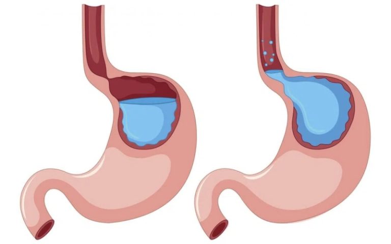 علائم خطرناک رفلاکس معده