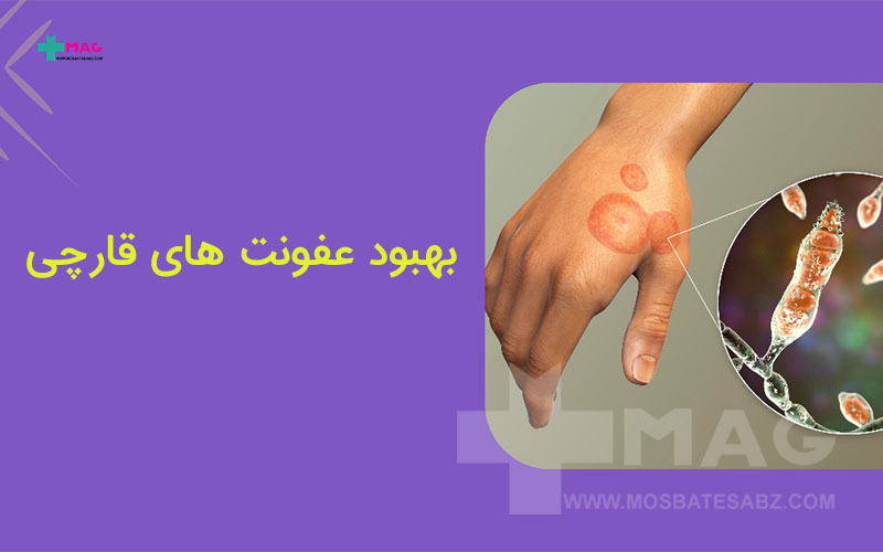 بهبود عفونت های قارچی