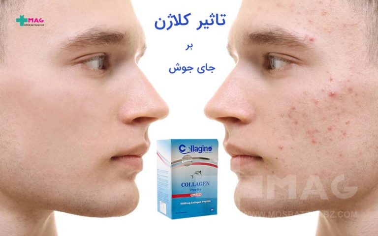 کلاژن و جای جوش
