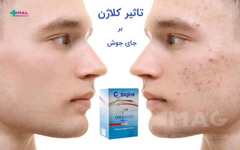 کلاژن و جای جوش