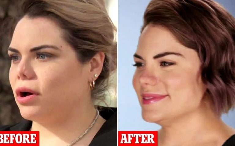 عمل بینی سر بالا یا خوکی
