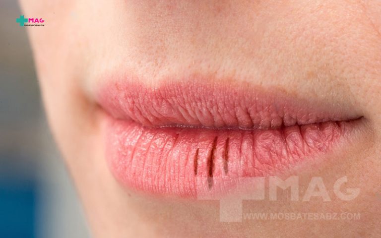 کمبود کدام ویتامین باعث خشکی دهان می شود