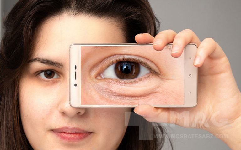 کمبود کدام ویتامین باعث پف زیر چشم می شود؟