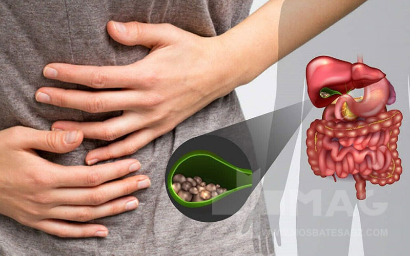 برای دفع سنگ کیسه صفرا چه بخوریم