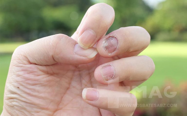 قارچ ناخن چیست؟