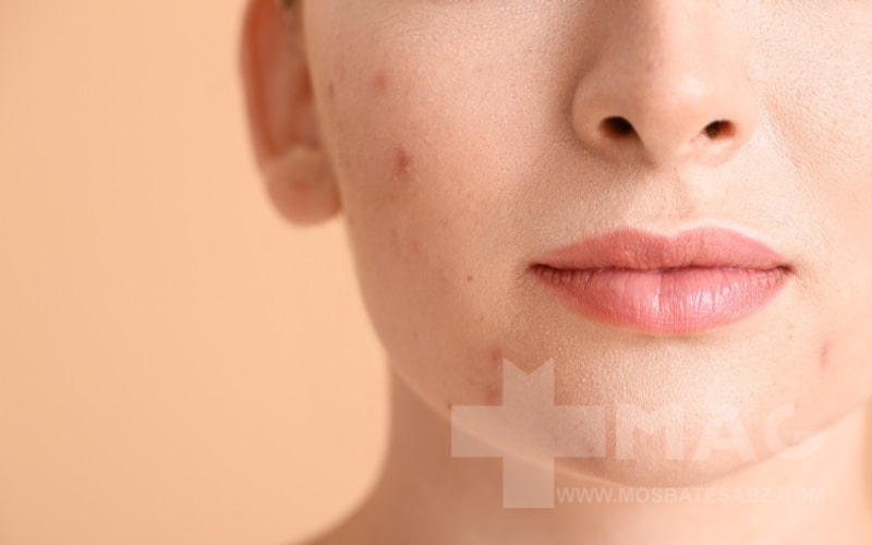 سابسیژن جای جوش چیست؟ بررسی تاثیر، مزایا، عوارض و هزینه آن