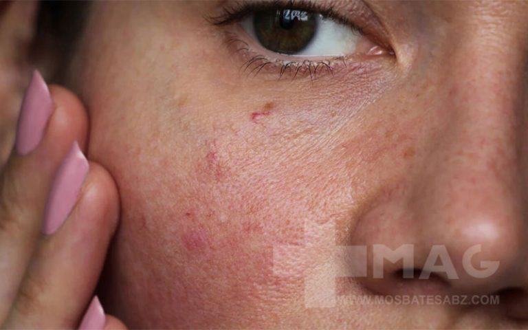 حساسیت پوستی و انواع آن
