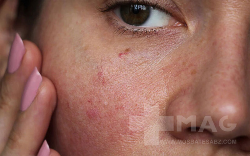 حساسیت پوستی و انواع آن