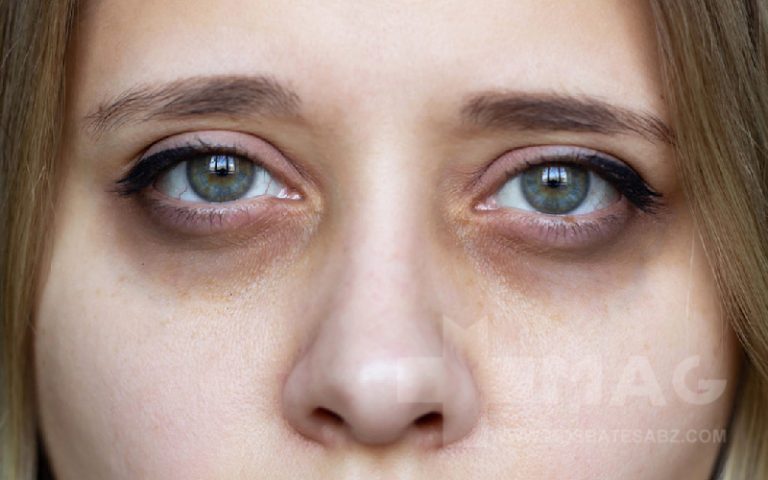سیاهی زیر چشم نشانه چیست
