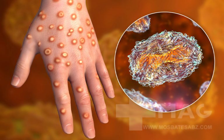 راه های تشخیص و درمان آبله میمونی