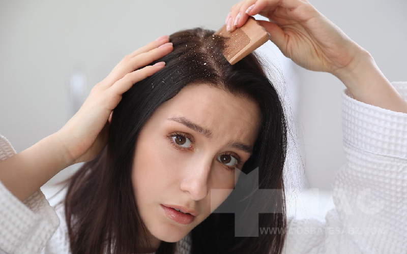 کمبود کدام ویتامین باعث شوره سر میشود