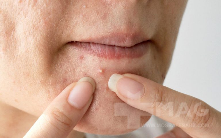 کمبود کدام ویتامین باعث جوش می شود؟
