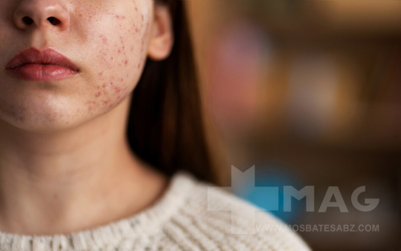 از بین بردن جای جوش