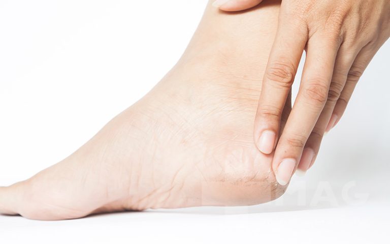 علائم خار پاشنه